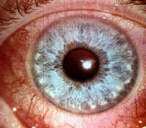 Eye Inflammation
