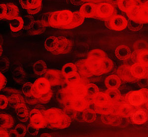 Anemia