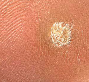 Warts