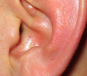 Ear Infections