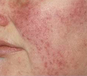 Rosacea