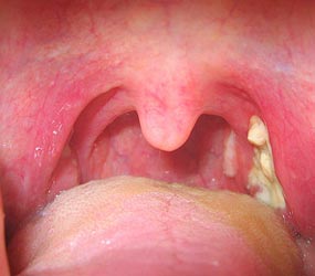 Sore Throat