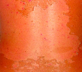 Sunburn